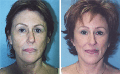 Before and After Facelift Surgery