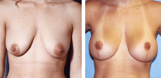 Lifting des seins Avant et après les photos