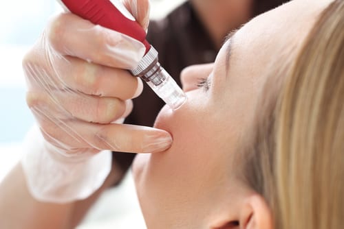 microneedle mesotherapy, treatment woman at the beautician-img-blog