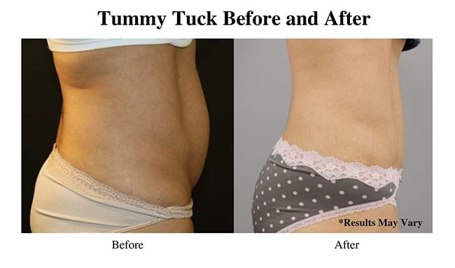 Before and after an image of a woman who underwent a tummy tuck after pregnancy.