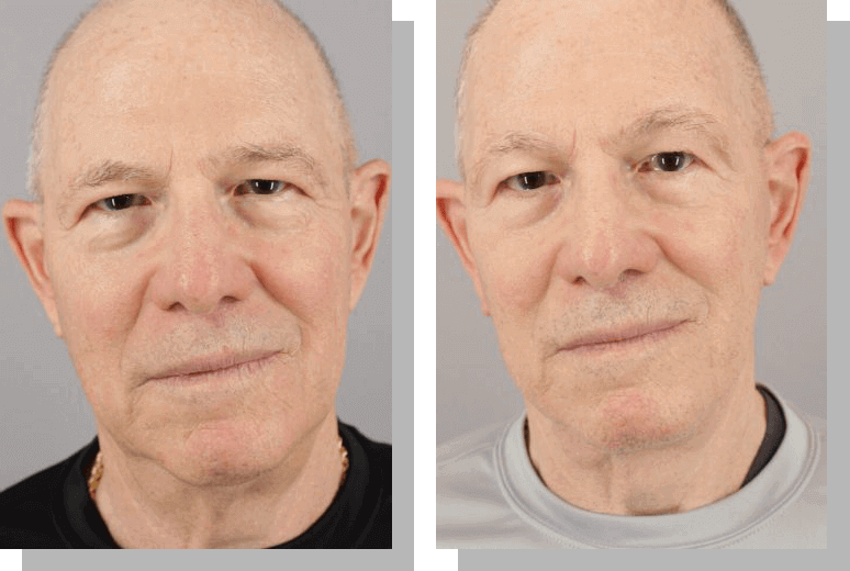 Facelift In Scottsdale Az Robert J Spies Md Facs