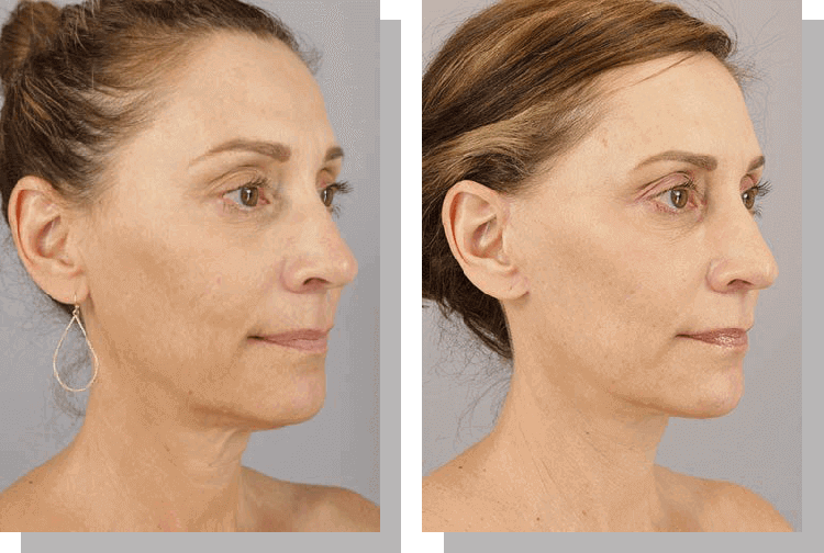 Facelift In Scottsdale Az Robert J Spies Md Facs