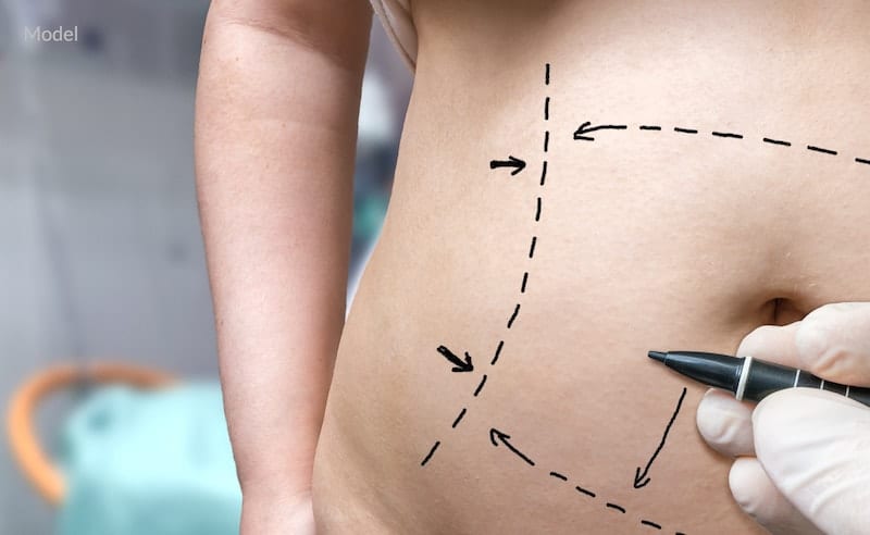 Abdominoplasty surgery preparation lines drawn on woman's abdomen.