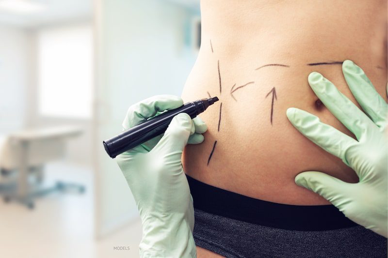 Surgeon drawing body contouring lines on woman's stomach