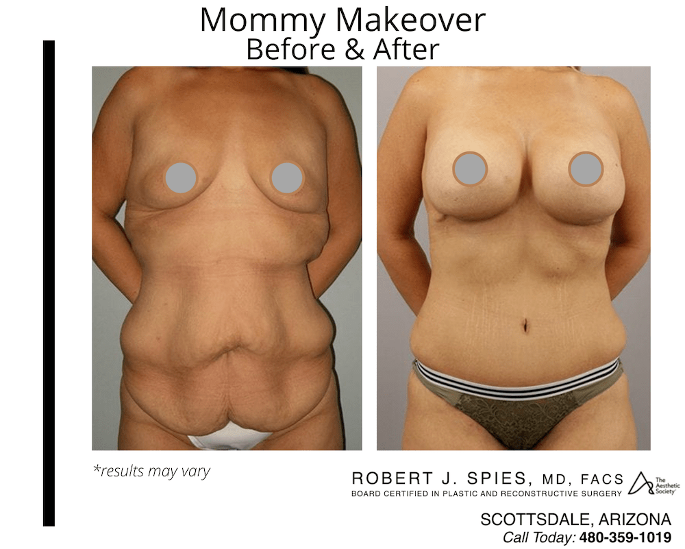 Before and after image showing the results of a Mommy Makeover performed in Scottsdale, AZ.