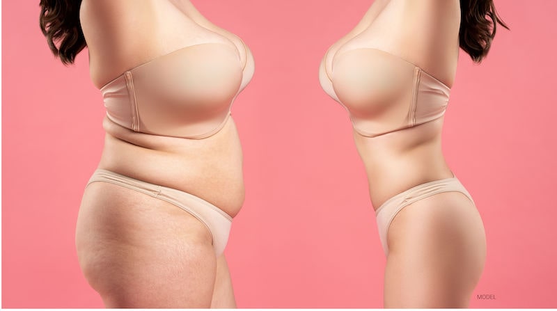 Tummy Tuck After Weight Loss and Pregnancy