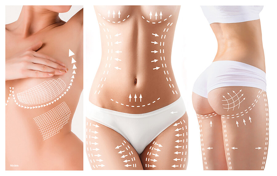 Plastic surgery concept - three images of woman's body, breasts, abdomen, and butt, with white dotted lines over each area