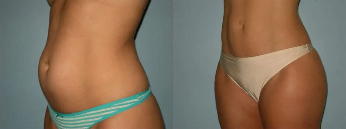 Actual Liposuction Patient results