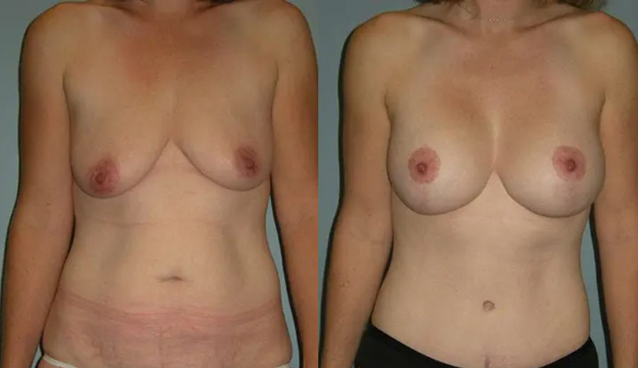 mommy makeover patient results