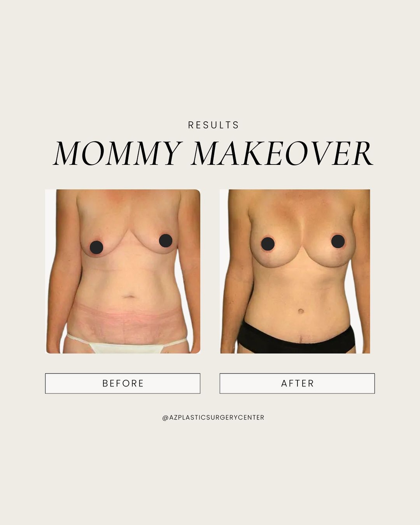 This mother of two came to Dr. Spies seeking a Mommy Makeover. Her main concerns were breast sagging, loss of volume, and loose skin of the abdomen. During consultation, Dr. Spies also identified separation of the rectus muscles. Her customized procedure included a tummy tuck, breast lift, and silicone implant placement. One year later, her results show significant improvement, with scars continuing to fade beautifully Call (480) 890-0600 to schedule your Mommy Makeover consultation with Dr. Spies in Scottsdale. #mommymakeover #mommymakeoverscottsdale #scottsdaleplasticsurgery #scottsdaleplasticsurgeon #bodycontouring #scottsdaleaz #plasticsurgeryaz