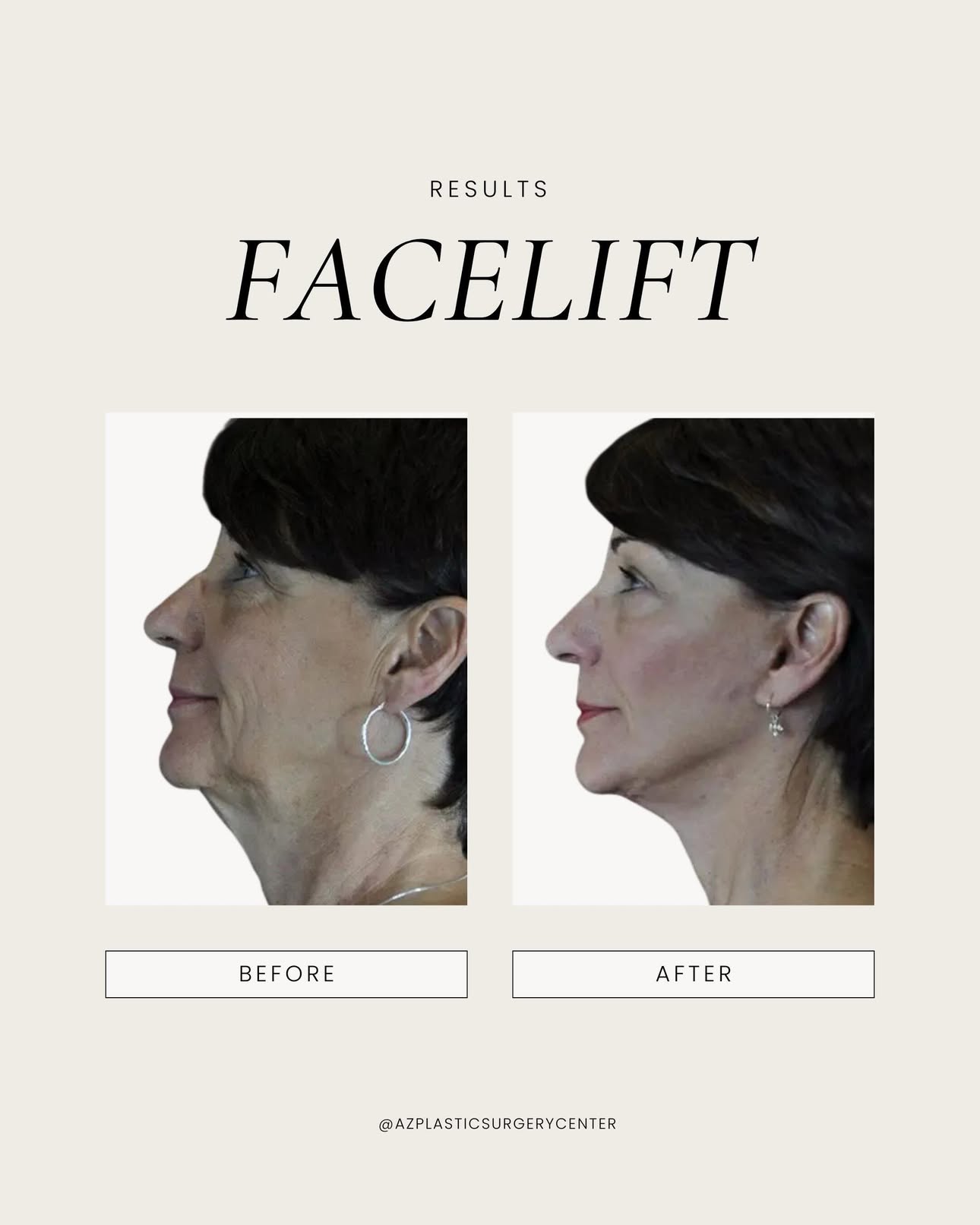 There is an art to a facelift that still looks like you, and Dr. Spies has mastered it. ⠀ This 65 year old patient came in wanting to look refreshed without looking overdone. Dr. Spies performed a facelift along with a lower eyelid lift, or blepharoplasty, to address both the face and the eyes for a balanced, natural result. ⠀ Call (480) 890-0600 or tap the link in our bio to schedule your consultation with Dr. Spies in Scottsdale, AZ. ⠀ #scottsdaleplasticsurgeon #scottsdalefacelift