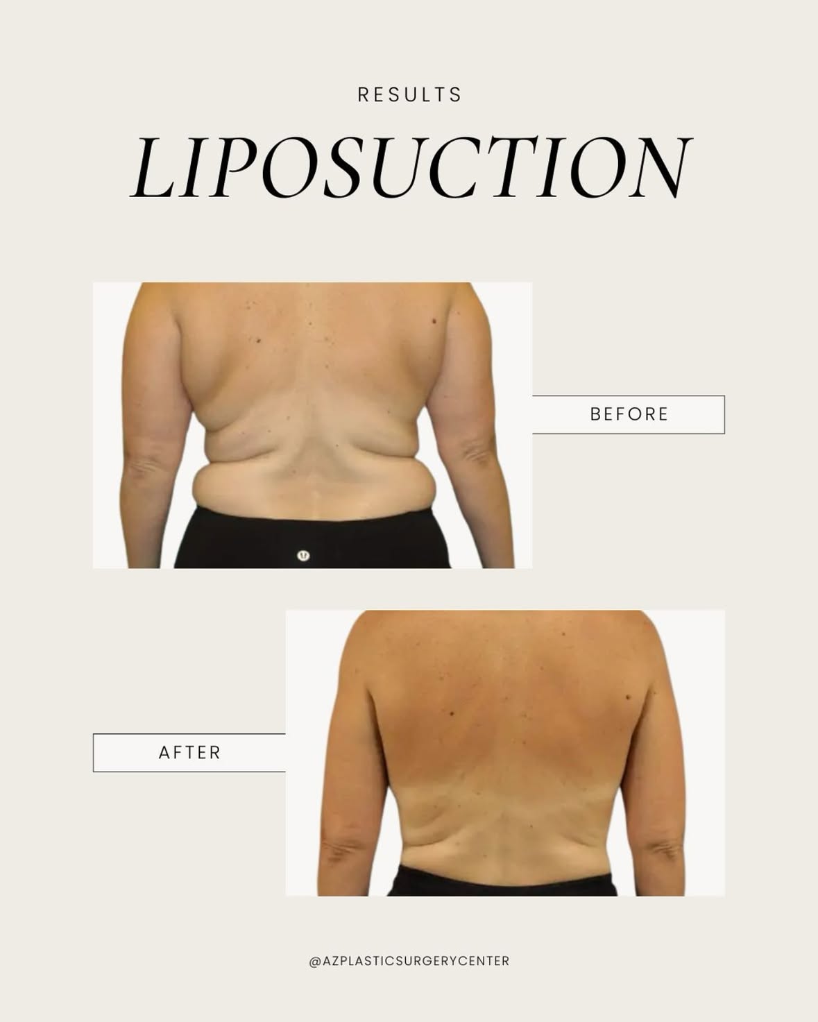 Liposuction is all about refinement. This patient wanted a smoother silhouette, and the results show how small adjustments can make a natural difference. Treatments like this are designed to enhance confidence and help patients feel more comfortable in their own skin. Call (480) 890-0600 to schedule a consultation with Dr. Spies in Scottsdale. #liposuction #bodycontouring #scottsdaleplasticsurgery #scottsdaleplasticsurgeon #scottsdaleaz #plasticsurgeryaz