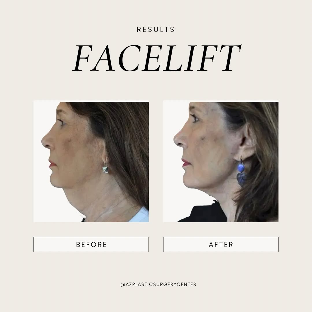 A closer look at facelift results This transformation focused on the lower face and neck to restore definition, smooth laxity, and create a more refreshed profile while still looking like her. The goal is balance, longevity, and results that age well. If you’ve been thinking about a facelift or want to understand what your options are, schedule a consultation with Dr. Spies. Call 480-890-0600 to book. #facelift #faceliftresults #beforeandafter