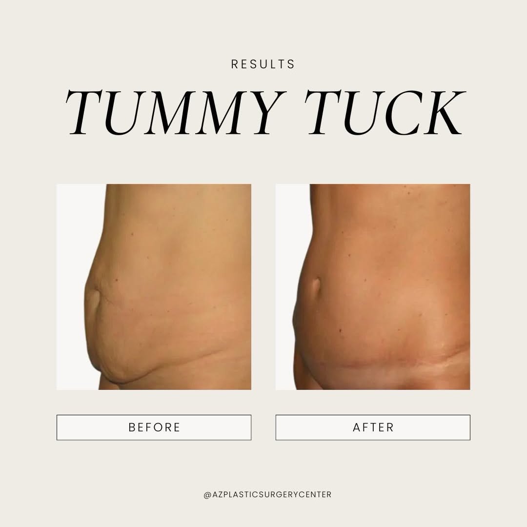This 46-year-old patient desired a flatter, more contoured abdomen after multiple pregnancies. A tummy tuck provided significant improvement, restoring her confidence and giving her the results she had been working toward. ⠀ Call (480) 890-0600 or tap the link in our bio to schedule your consultation with Dr. Spies in Scottsdale, AZ. ⠀ #tummytuck #tummytuckscottsdale