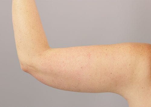 Arm Lift Patient 03 - After 