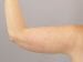 Arm Lift Patient 03 - After Thumbnail 