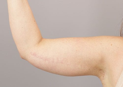 Arm Lift Patient 03 - After 