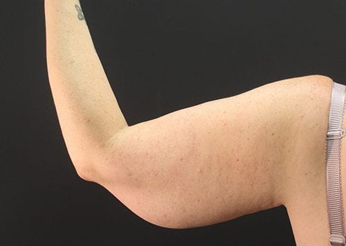 Arm Lift Patient 03 - Before 