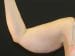 Arm Lift Patient 03 - Before Thumbnail 