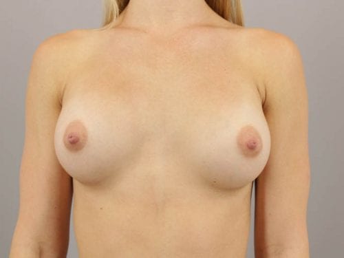 Breast Augmentation Patient 03 - After 