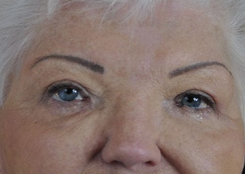 Blepharoplasty Patient 05 - After 