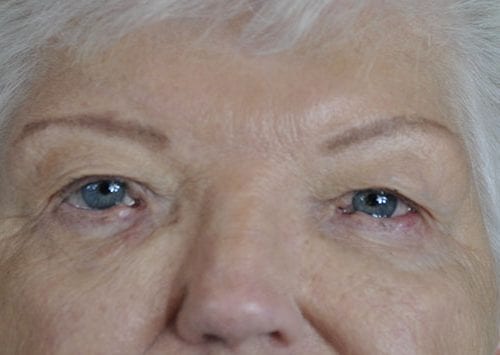 Blepharoplasty Patient 05 - Before 