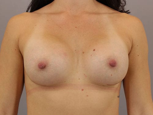 Breast Augmentation Patient 38 - After 