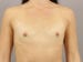 Breast Augmentation Patient 38 - Before Thumbnail 