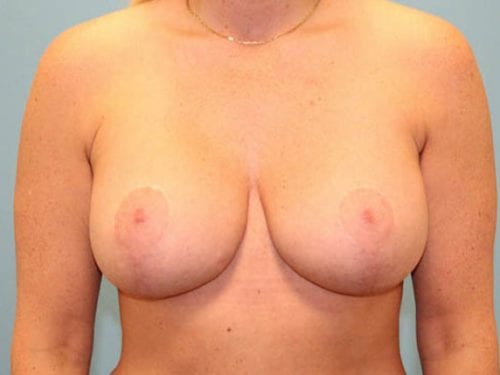 Breast Lift Patient 03 - After 