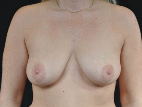 Breast Lift Patient 03 - Before 