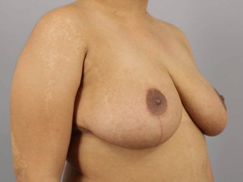 Breast Reduction Patient 02 - After 