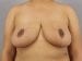 Breast Reduction Patient 02 - After Thumbnail 