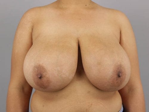 Breast Reduction Patient 02 - Before 