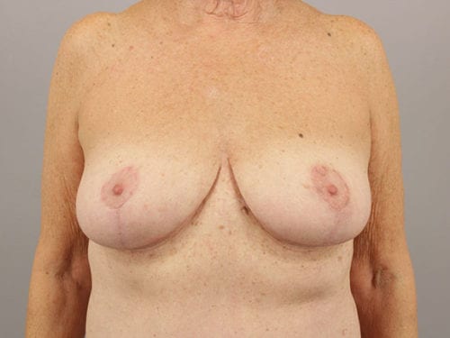 Breast Reduction Patient 08 - After 
