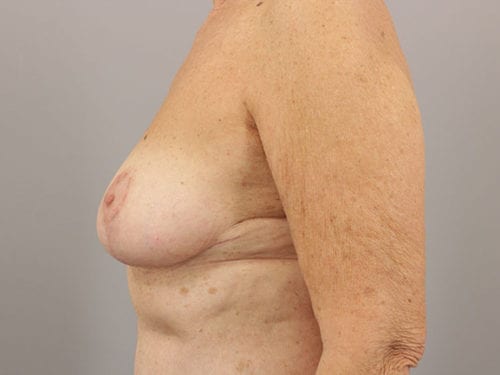 Breast Reduction Patient 08 - After 