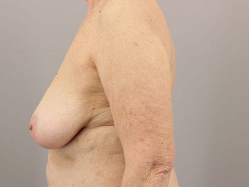Breast Reduction Patient 08 - Before 