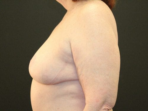 Breast Reduction Patient 05 - After 