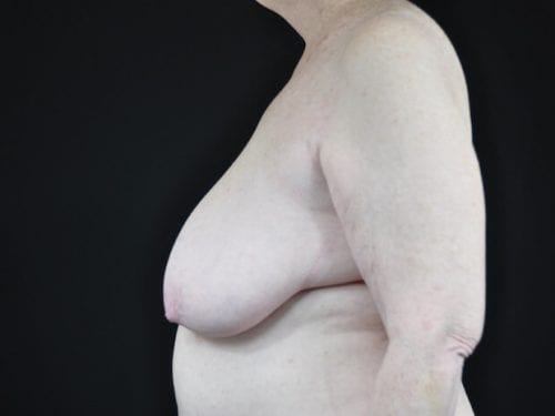 Breast Reduction Patient 05 - Before 