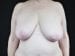 Breast Reduction Patient 05 - Before Thumbnail 