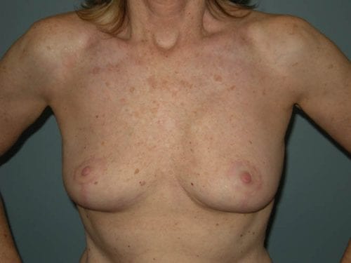 Breast Revision Patient 01 - After 