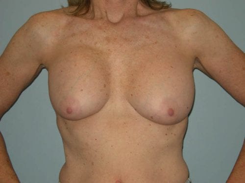 Breast Revision Patient 01 - Before 