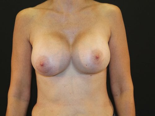 Breast Revision Patient 04 - Before 