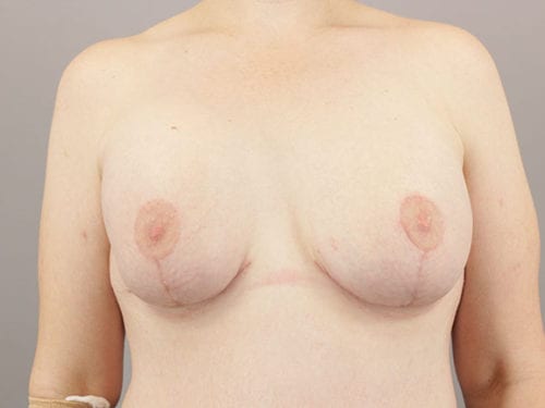 Breast Revision Patient 14 - Before 