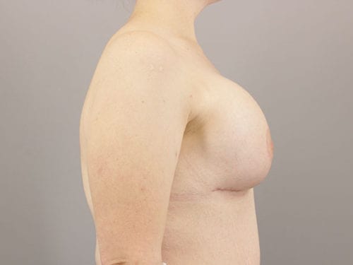 Breast Revision Patient 14 - Before 