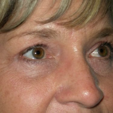 Brow Lift Patient 01 - After 
