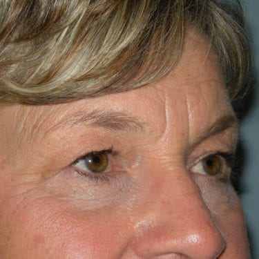 Brow Lift Patient 01 - Before 