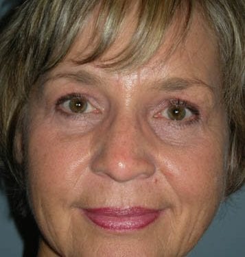 Brow Lift Patient 01 - After 