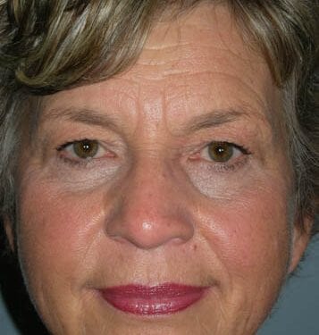 Brow Lift Patient 01 - Before 
