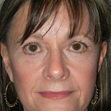 Brow Lift Patient 09 - After 