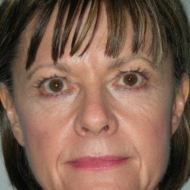 Brow Lift Patient 09 - Before 